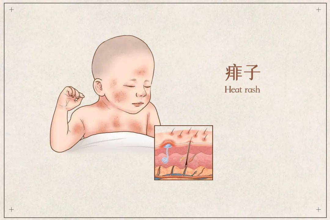 去除婴儿热疹小妙招_湿疹是一热就红一凉就不红