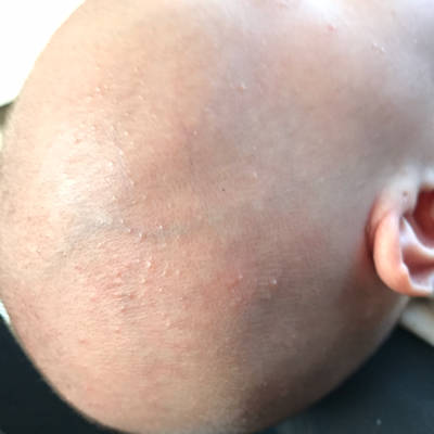 去除婴儿热疹小妙招_去除婴儿热疹小妙招有哪些