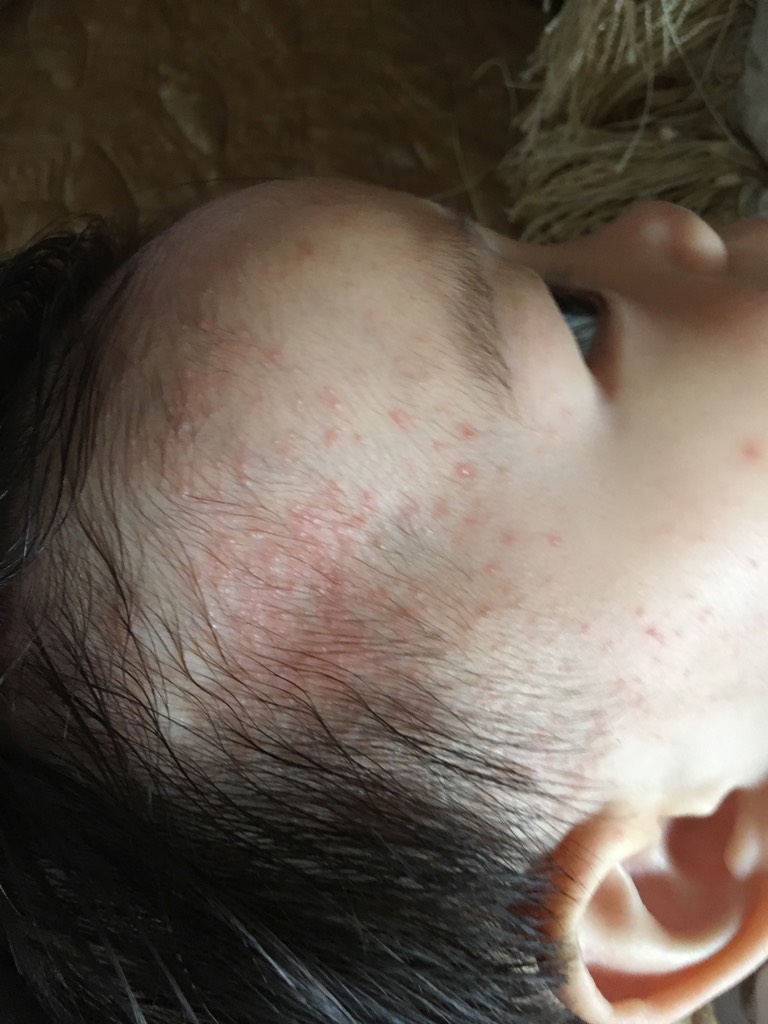 去除婴儿热疹小妙招_去除婴儿热疹小妙招有哪些